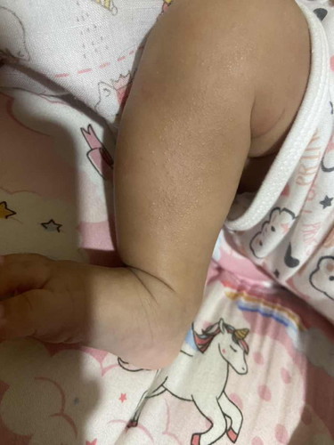 ผื่นที่ขา/แขนน้อง