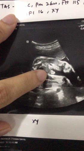 Gender baby