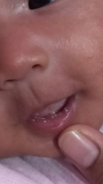 Bibir bayi putih