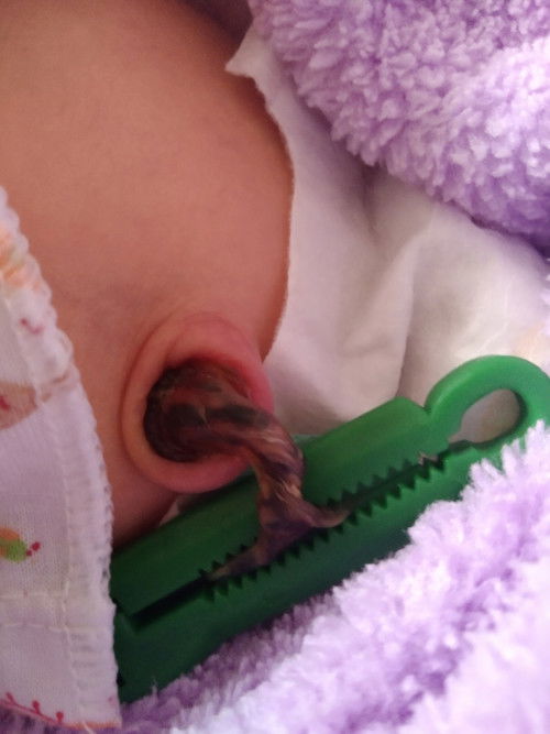 สอบถามเราต้องเอาที่หนีบออกไหม