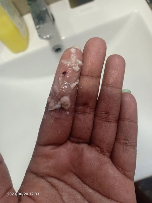 Whitedischarge with blood clot