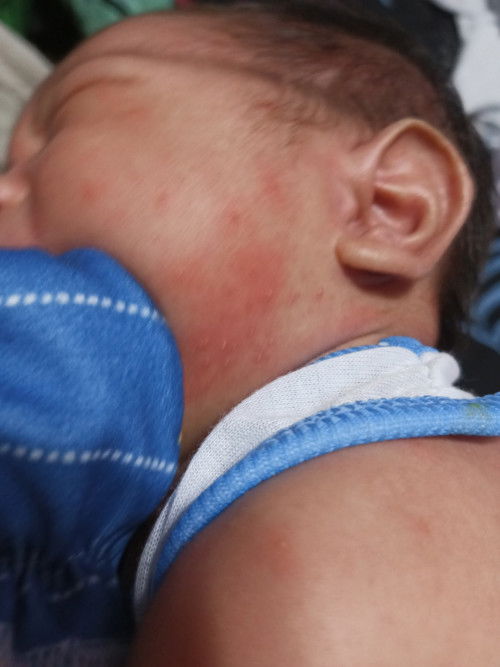 BABY ACNE sa 2weeks old baby ko
