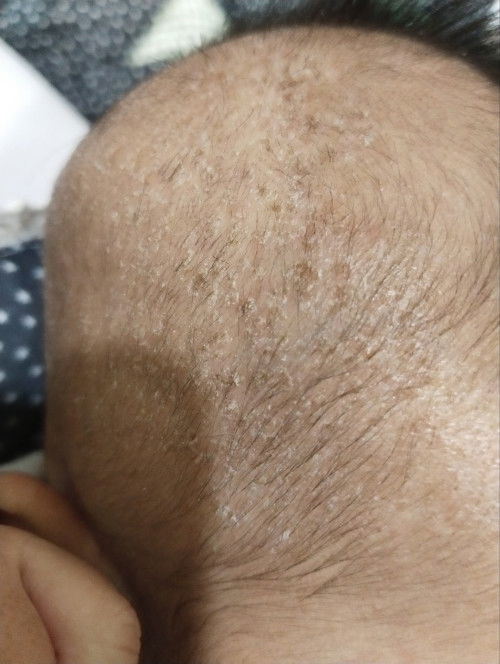 Slm. Nk tanya ibu² berpengalaman ada tak yg kena mcm ni? Kepala baby jadi mengelupas gitu kering