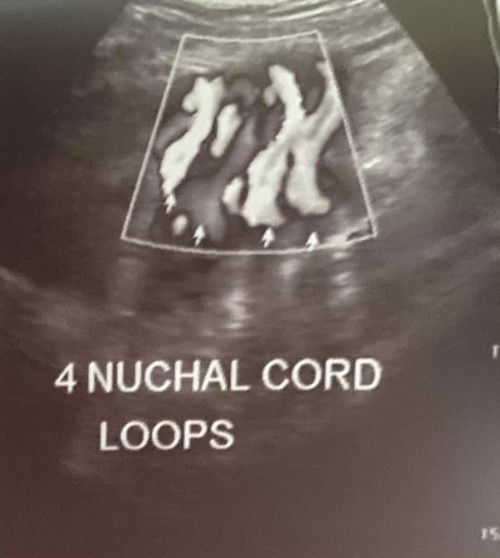 4 nuchal cord loops