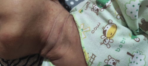 Kulit bayi bruntusan