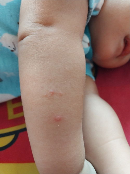 Apakah ini cacar air