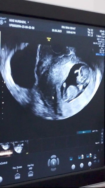 Plasenta lepas sebagian