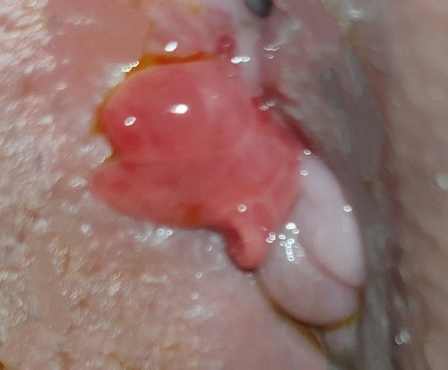 Muncul Daging merah menonjol di pintu vagina pasca melahirkan normal