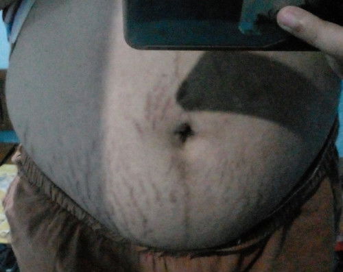 Ano po kayang pedeng gamiting product para mag lighten ang Stretchmarks?