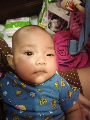 Ada ngga bun yg anaknya seperti ini matanya sipit sebelah, apakah nanti bisa normal?