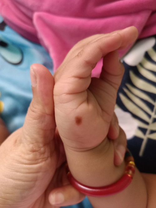 Color brown spot sa kamay ni baby