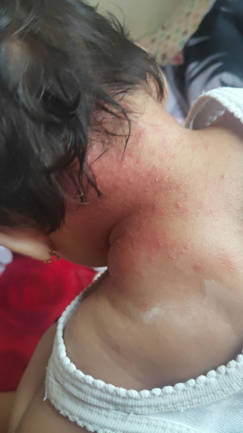 Ruam leher biang keringat cara hilangkan gmna moms udh mandi pakek lactacyd baby malah kyk parah