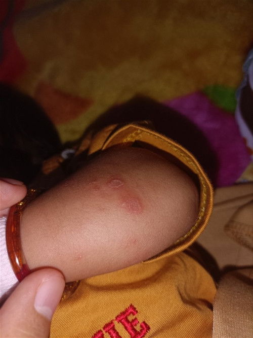 ruam merah seperti herpes