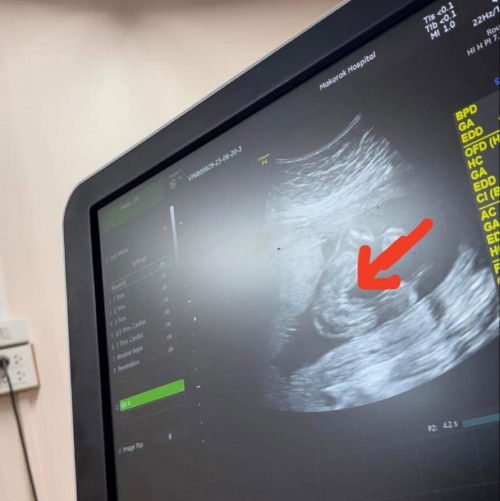 แม่ๆช่วยดูหน่อยค่า แบบนี้ชัดเจนแล้วใช่มั้ยคะ คุณหมอบอกว่า ผู้หญิง 80% ค่ะ 😹😹