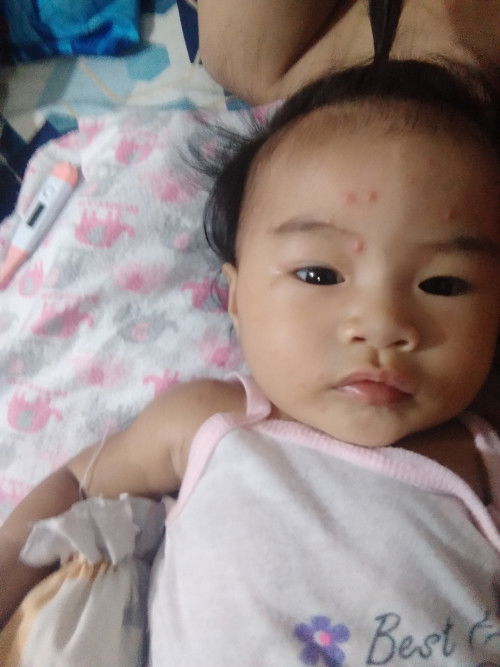Chicken pox of 4 month old.