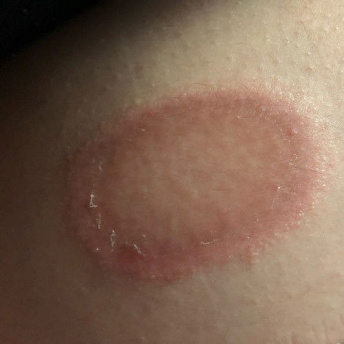 Infeksi jamur/ kurap