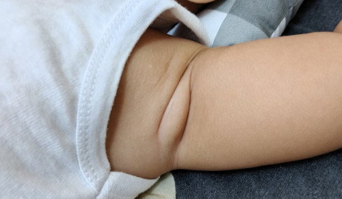 Bengkak di ketiak kiri pada bayi