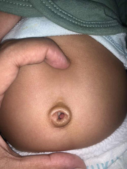 Obat untuk Granuloma Umbilikalis