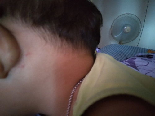 ลูกชายชอบมีตุ่มแดงขึ้นข้างหลังใบหู แล้วน้องชอบเอามือตีที่หู คืออาการอะไรค่ะ แม่ๆ