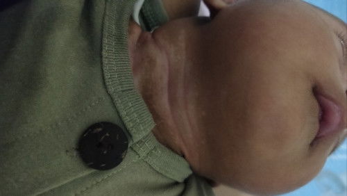 Bercak putih di leher