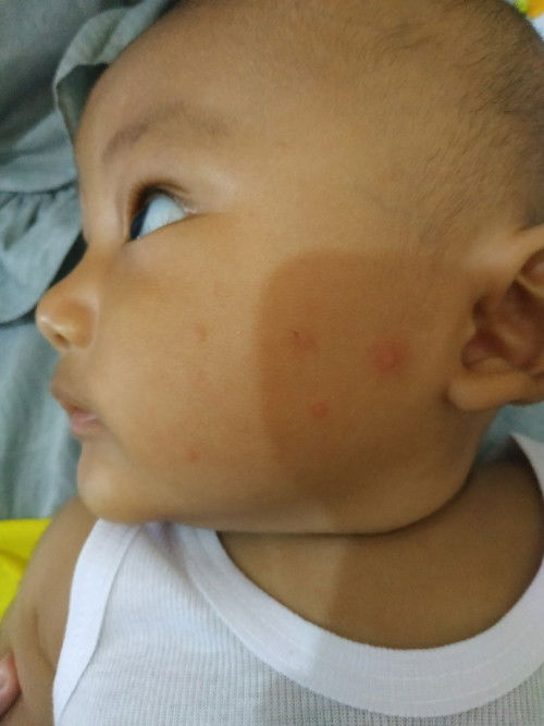 Alergi atau ruam merah