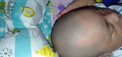 Bintik bintik putih berair