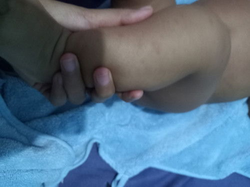 Bekas gigitan nyamuk