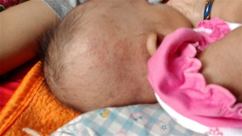 Bun ini termasuk biang keringat atau alergi ya?