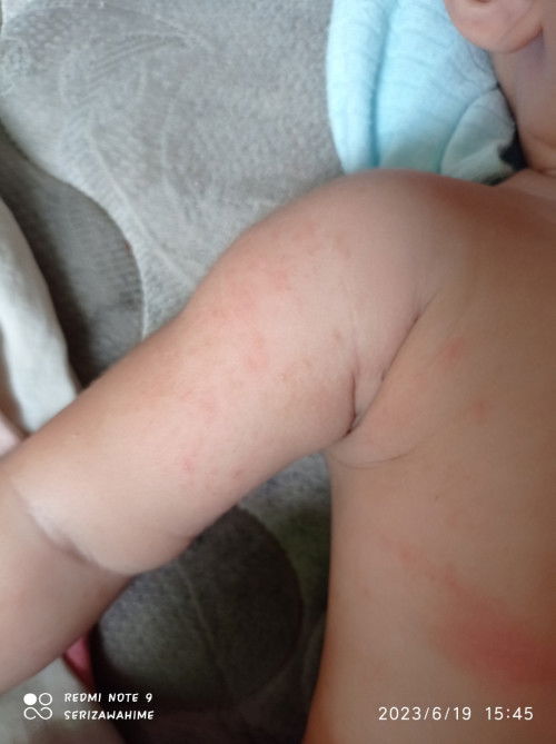 Bintik bintik di tubuh bayi