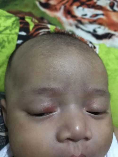 Kemerahan di kelopak mata