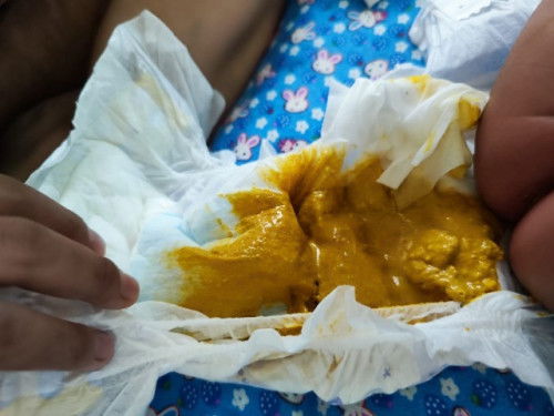 Bayi cirit campur susu formula dan susu badan