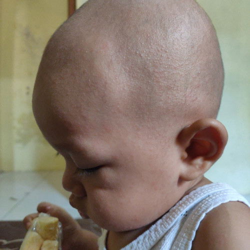 Hallo bunda, Mohon bantuannya..
Ini biang keringat bukan ya, semakin lama semakin banyak.