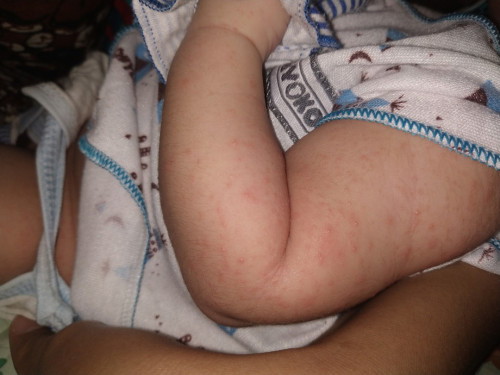 Gatal pada bayi 0 bln