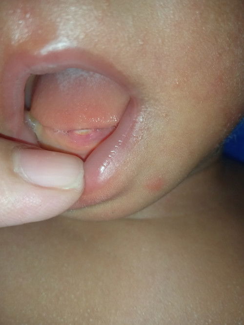 Bayi 20 hari tunbuh gigi