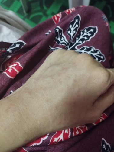 mommy mommy lepas bersalin pernah lalui tak mcm ni .. Ruam merah gatal satu badan selepas bersalin