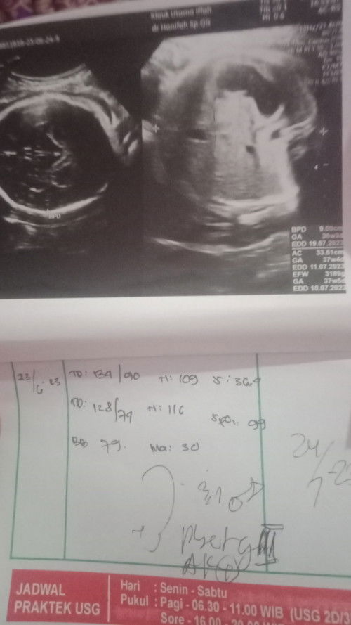 EDD hari perkiraan lahir