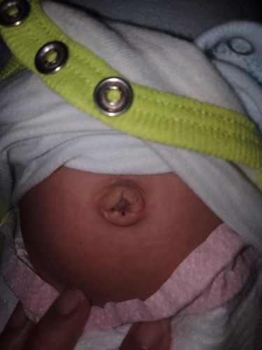 Umbilical problem