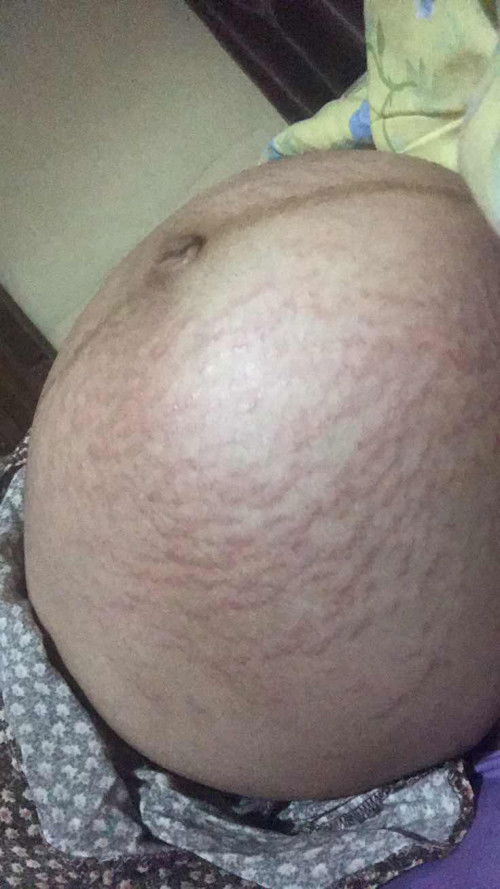 Stretch mark parah dan ruam