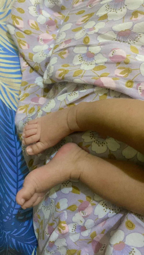 Warna tangan & kaki beda dgn badan