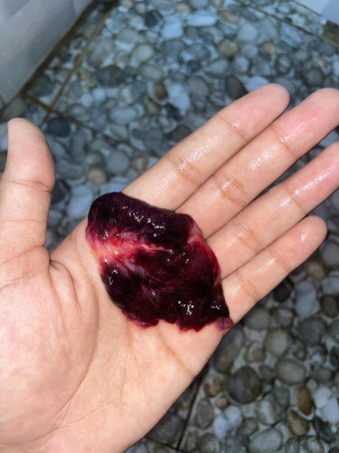 Tak tahu keguguran berapa weeks sbb period tak teratur. Dh scan klinik swasta sebelum ni tp x nampak