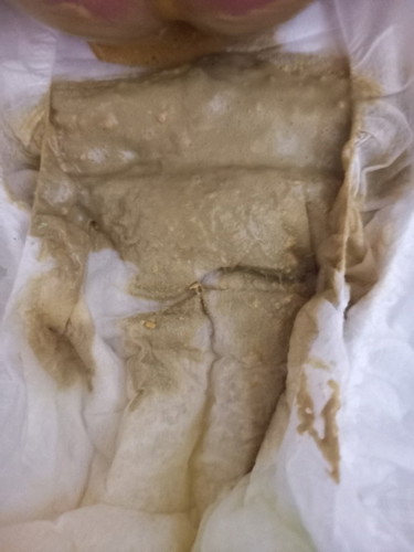 อึแบบนี้ผิดปกติไหมคะ