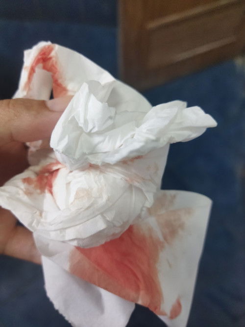 ขอสอบถามแม่ๆหน่อยค่ะพอดีมะกี้ไปฉี่มาแล้วมีเลือดออกมาด้วยจะส่งผลกระทบกับลูกในท้องไหมคะ