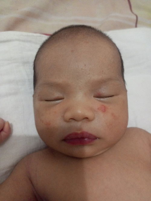 Bintik merah pada wajah bayi