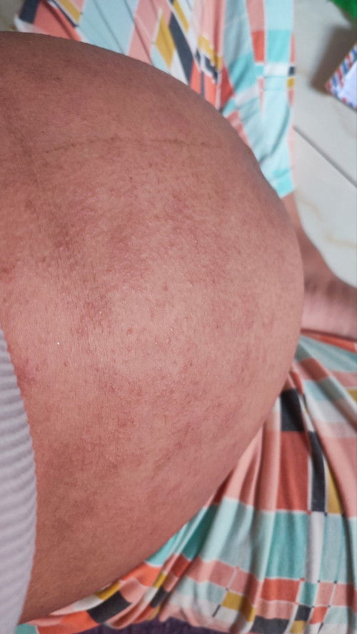 Perut gatal seperti biang keringat