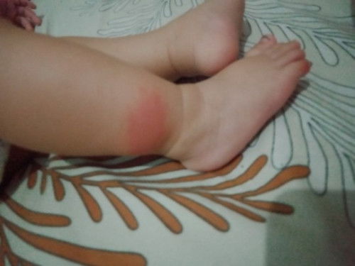 Gatal pada bayi 7 bulan