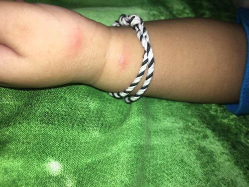 gigitan nyamuk/serangga ya