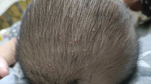 Bruntusan di kulit kepala