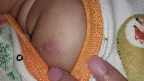 Bekas suntikan imunisasi bcg