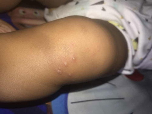 Gatal gatal pda bayi