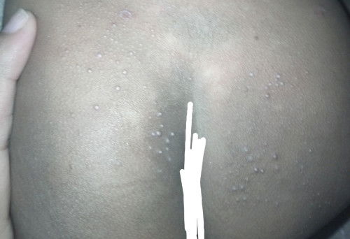 pantat bintik bintik